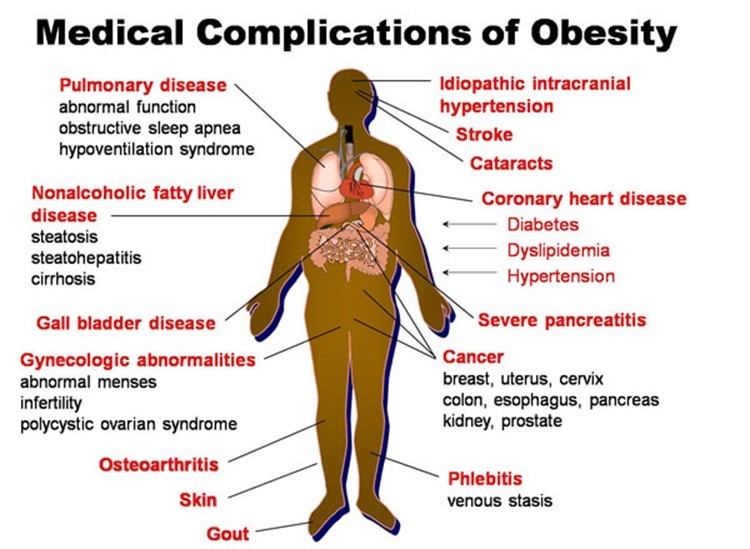 Medical Complications of Obesity